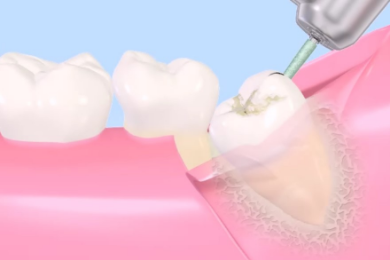 歯牙の分割