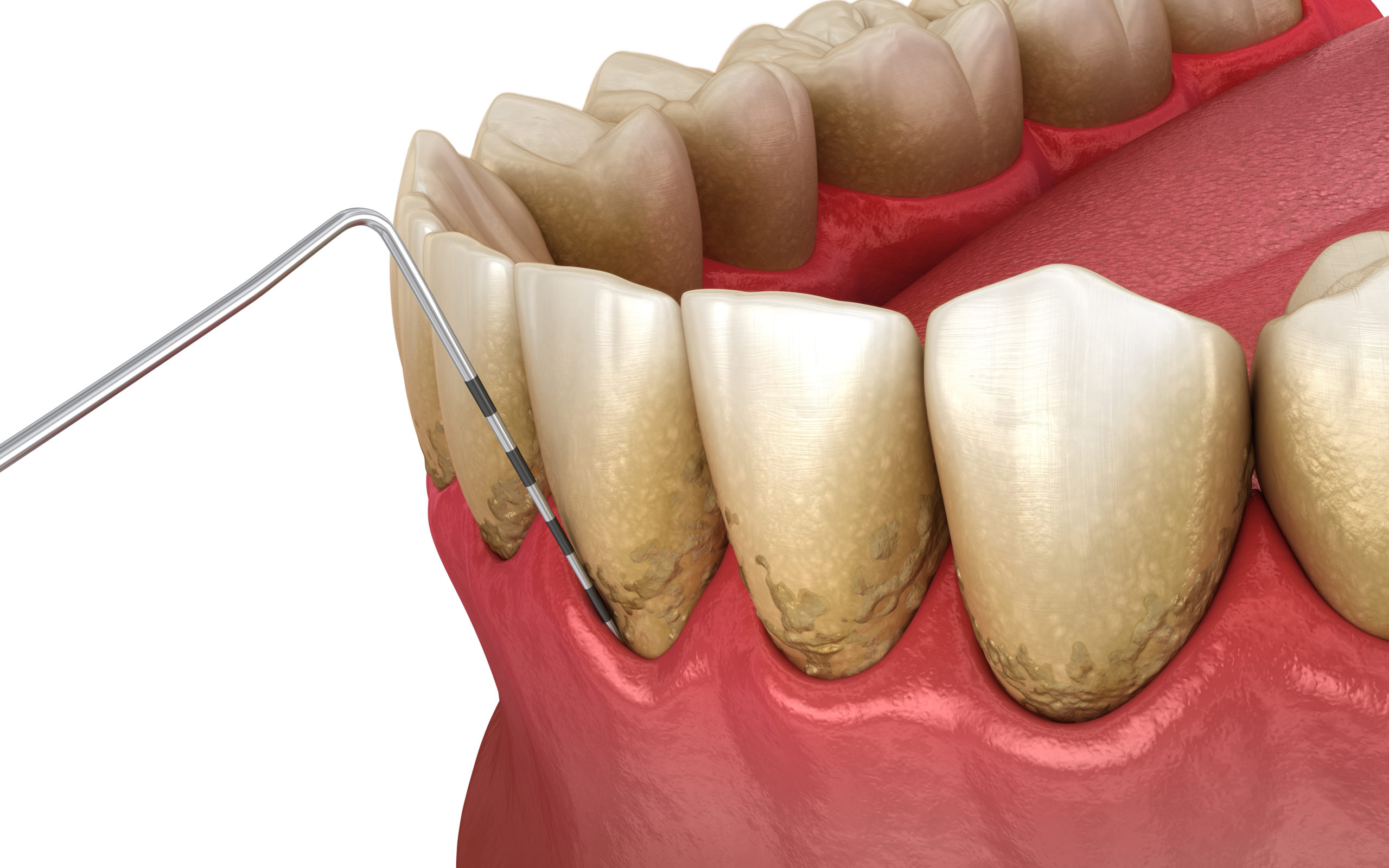 歯周組織検査　イメージ画