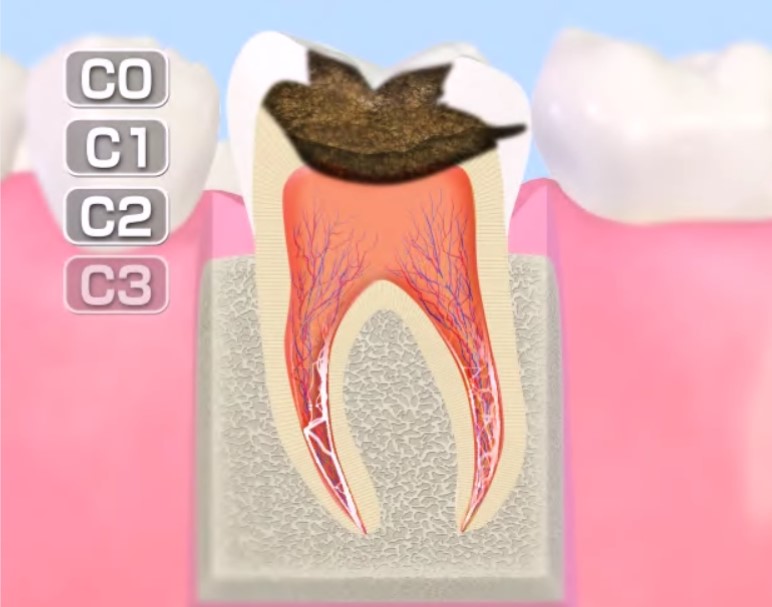 歯髄　イメージ画