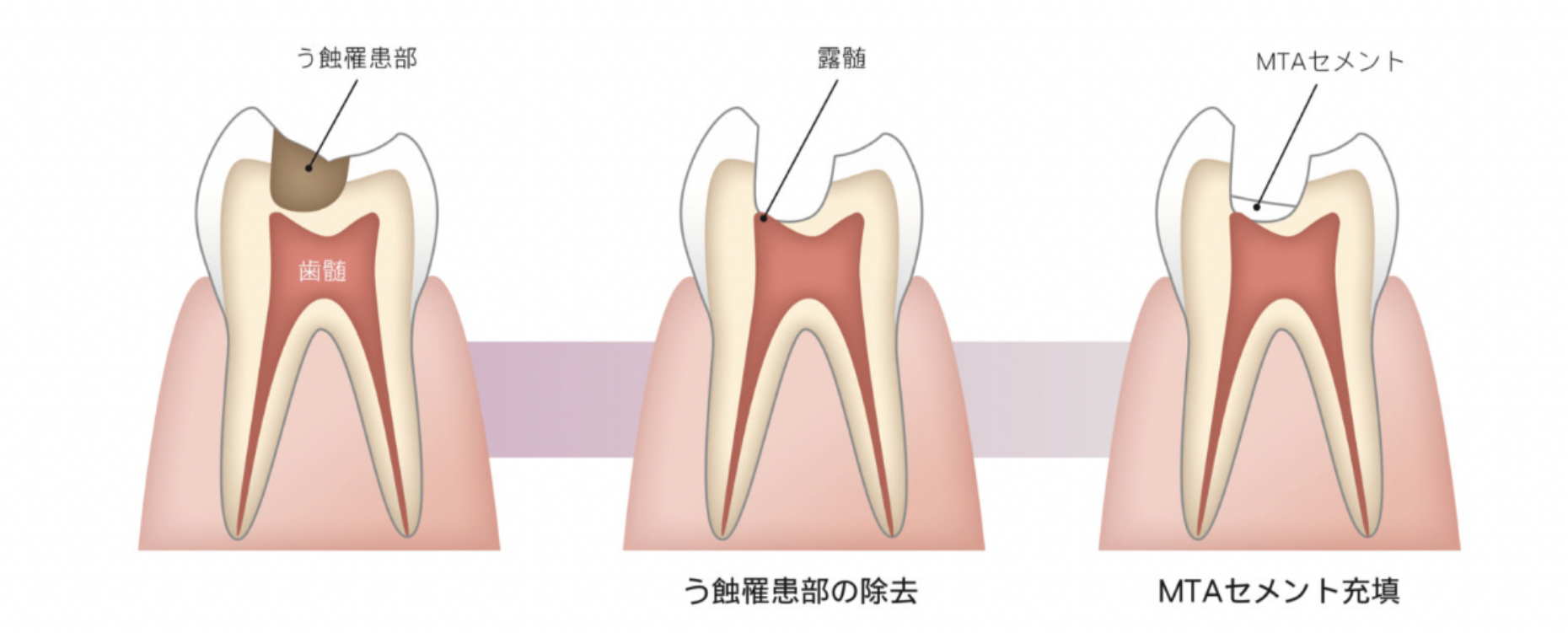 虫歯の削り方　イメージ